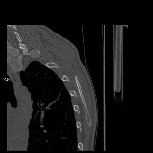 Avascular necrosis after fracture dislocations of the proximal humerus (Radiopaedia 88078-104655 Sagittal bone window 89).jpg