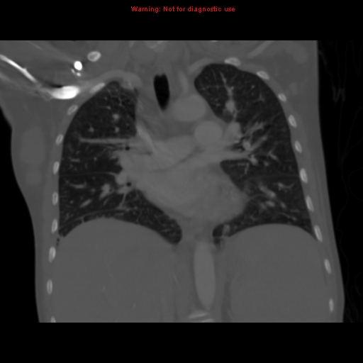 File:Avascular necrosis in sickle cell disease (Radiopaedia 17448-17152 Coronal bone window 67).jpg