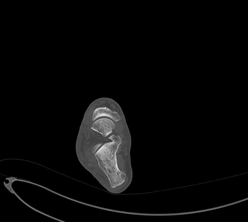 Avulsion fractures of talus and calcaneus (Radiopaedia 48277-53155 Axial bone window 47).jpg