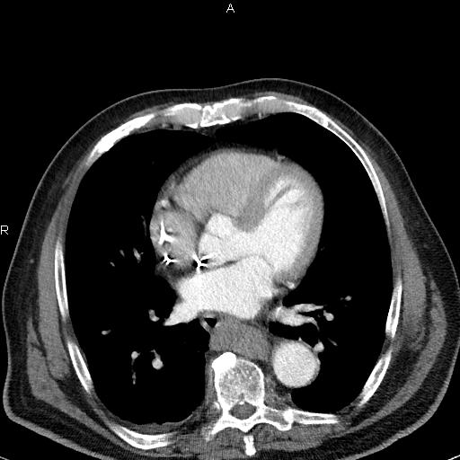 File:Azygos continuation of the inferior vena cava (Radiopaedia 18537-18404 C+ arterial phase 35).jpg