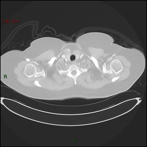 Azygos fissure and lobe (Radiopaedia 47620-52278 Axial lung window 3).jpg