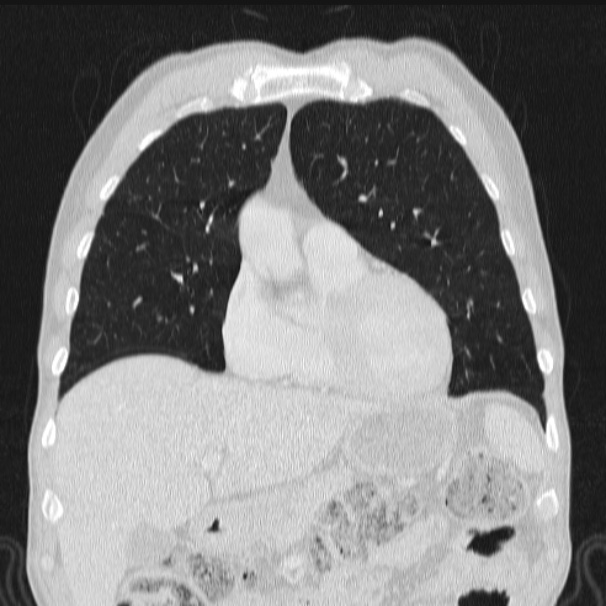 Azygos lobe (Radiopaedia 38259-40275 Coronal lung window 25).jpg