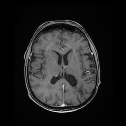 File:Balo concentric sclerosis (Radiopaedia 53875-59982 Axial LAVA C+ 150).jpg