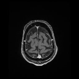 Balo concentric sclerosis (Radiopaedia 53875-59982 Axial LAVA C+ 230).jpg