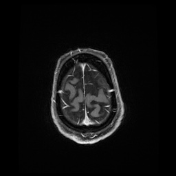Balo concentric sclerosis (Radiopaedia 53875-59982 Axial LAVA C+ 237).jpg