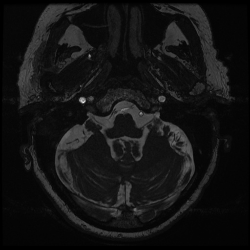 File:Balo concentric sclerosis (Radiopaedia 53875-59982 Axial T2 FIESTA 16).jpg