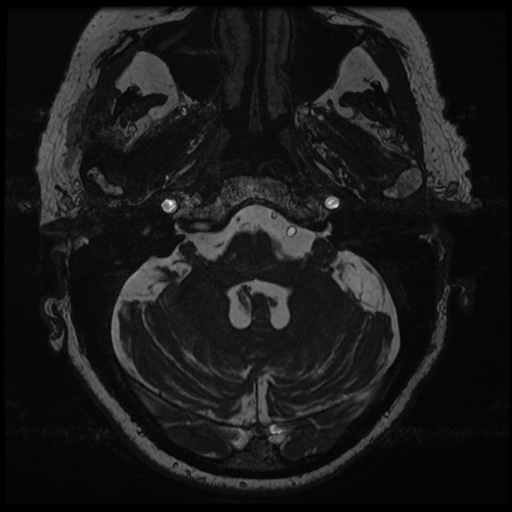 File:Balo concentric sclerosis (Radiopaedia 53875-59982 Axial T2 FIESTA 21).jpg