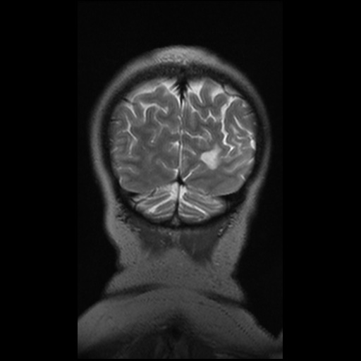 Balo concentric sclerosis (Radiopaedia 53875-59982 Coronal T2 11).jpg