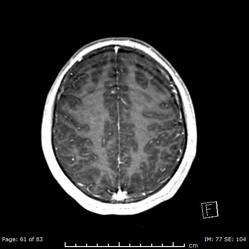 Balo concentric sclerosis (Radiopaedia 61637-69636 Axial T1 C+ 61).jpg