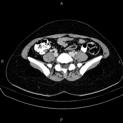 File:Bartholin gland cyst (Radiopaedia 62635-70930 Axial Post contrast 9).jpg