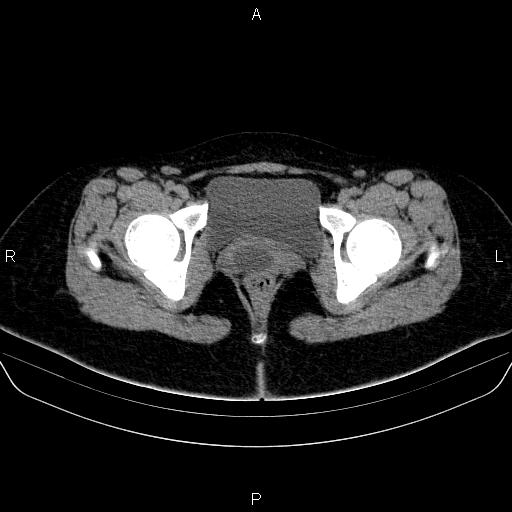 File:Bartholin gland cyst (Radiopaedia 62635-70930 Axial non-contrast 71).jpg