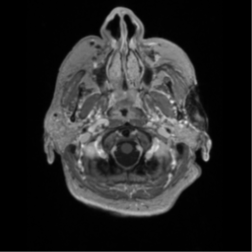 Basal ganglia metastasis (Radiopaedia 78928-91828 Axial T1 C+ 3).png