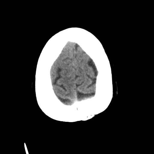 Basal ganglia metastasis (Radiopaedia 78928-91830 Axial non-contrast 53).png