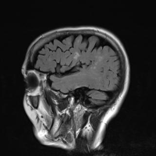 File:Base of skull chondrosarcoma (Radiopaedia 30410-31070 Sagittal FLAIR 2).jpg