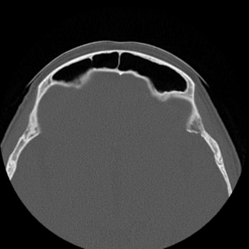 File:Base of skull chondrosarcoma (Radiopaedia 30410-31071 Axial bone window 37).jpg