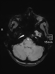 Basilar artery perforator aneurysm (Radiopaedia 82455-99523 Axial SWI 13).jpg