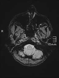Basilar artery perforator aneurysm (Radiopaedia 82455-99523 Axial SWI 5).jpg