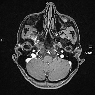 File:Basilar artery perforator aneurysm (Radiopaedia 82455-99523 G 15).jpg