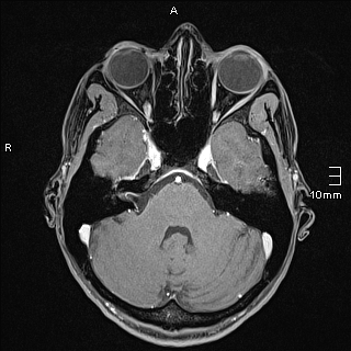 File:Basilar artery perforator aneurysm (Radiopaedia 82455-99523 G 33).jpg