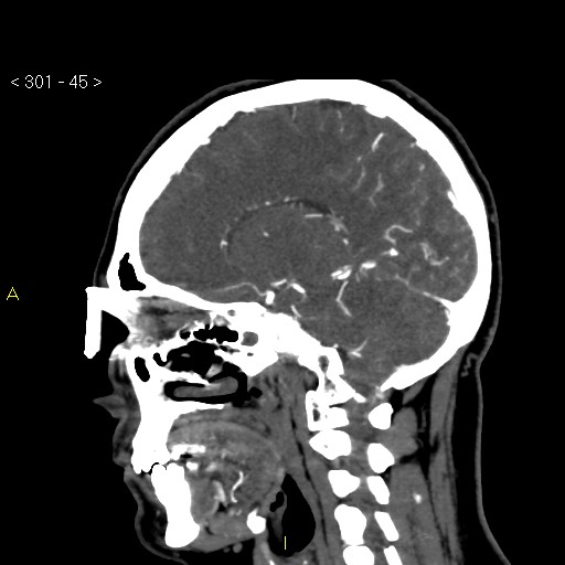 Basilar artery thrombosis (Radiopaedia 16260-15944 C 39).jpg