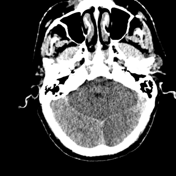 Basilar artery thrombosis (Radiopaedia 53351-59352 Axial non-contrast 36).jpg