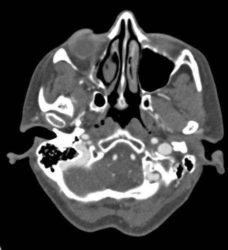 Basilar tip aneurysm with coiling (Radiopaedia 53912-60086 A 24).jpg
