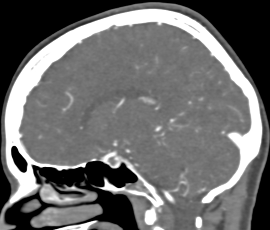 Basilar tip aneurysm with coiling (Radiopaedia 53912-60086 C 56).jpg