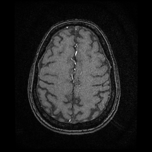 Basilar top and left middle cerebral artery aneurysm (Radiopaedia 61965-70031 Axial MRA 133).jpg