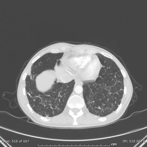 Behçet disease (Radiopaedia 44247-47889 Axial lung window 72).jpg