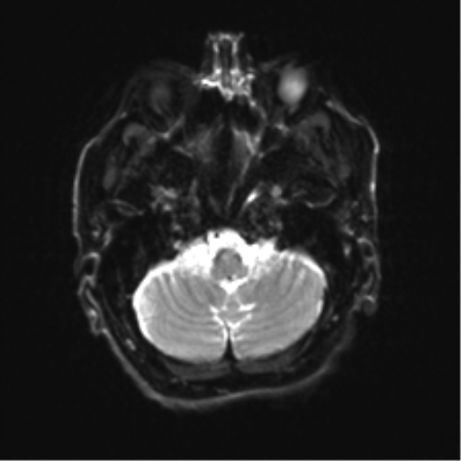 File:Behavioral variant frontotemporal dementia and late onset schizophrenia (Radiopaedia 52197-58083 Axial DTI Trace W 5).png