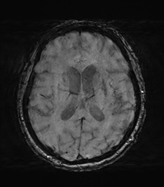 File:Behavioral variant frontotemporal dementia and late onset schizophrenia (Radiopaedia 52197-58083 Axial SWI 43).png