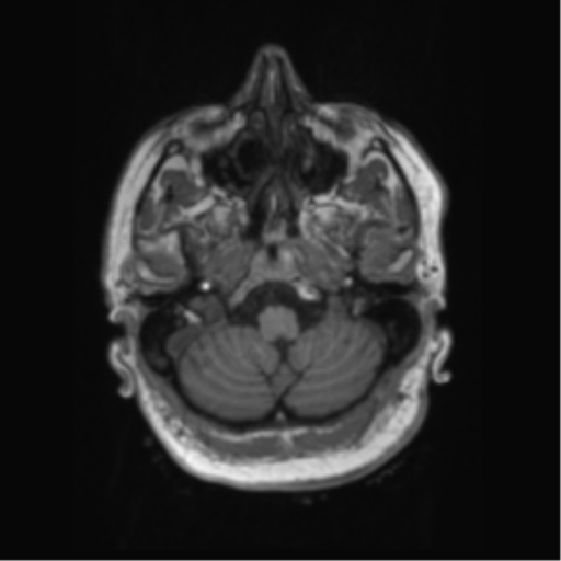 File:Behavioral variant frontotemporal dementia and late onset schizophrenia (Radiopaedia 52197-58083 Axial T1 96).png