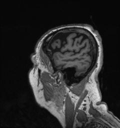 File:Behavioral variant frontotemporal dementia and late onset schizophrenia (Radiopaedia 52197-58083 Sagittal T1 99).png