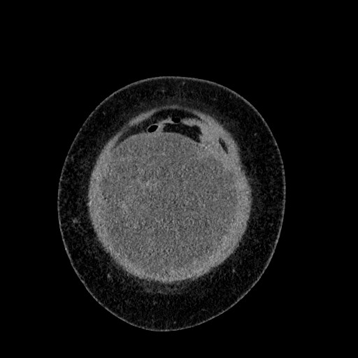 Benign leiomyoma with hydropic features (Radiopaedia 89250-106130 B 14).jpg