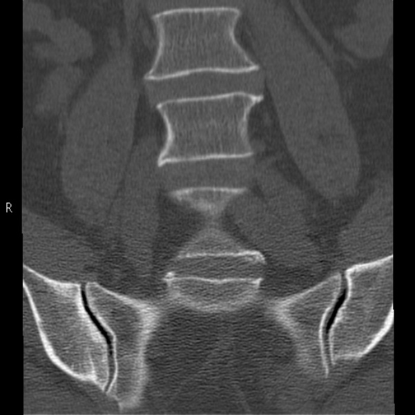Bertolotti syndrome (Radiopaedia 24864-25128 Coronal bone window 12).jpg