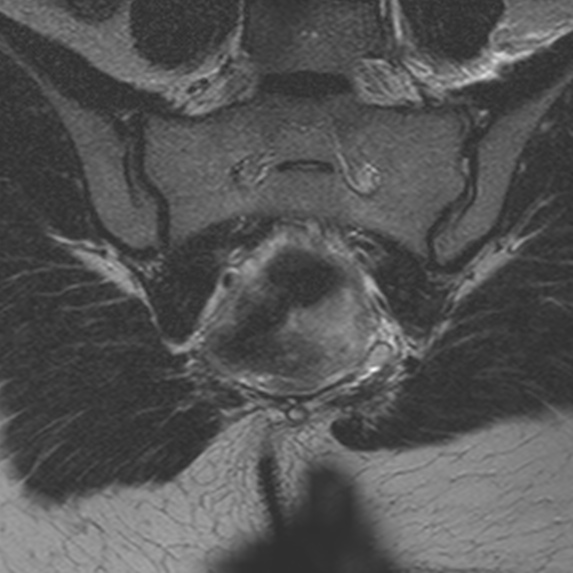 File:Bicornuate uterus (Radiopaedia 24677-24949 Coronal T2 21).jpg