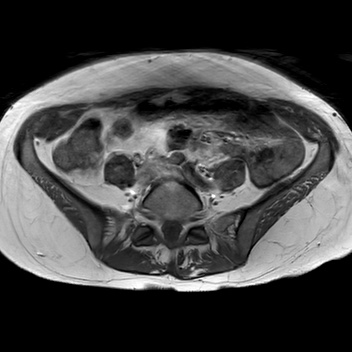 File:Bicornuate uterus (Radiopaedia 61974-70046 Axial T1 14).jpg