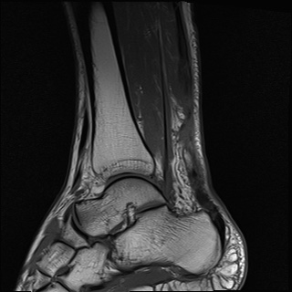 File:Bilateral Achilles tendon complete tear (Radiopaedia 81344-95051 Sagittal T1 22).jpg