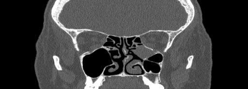 Bilateral Ectopic Infraorbital Nerves (Radiopaedia 49006-54084 Coronal bone window 42).jpg
