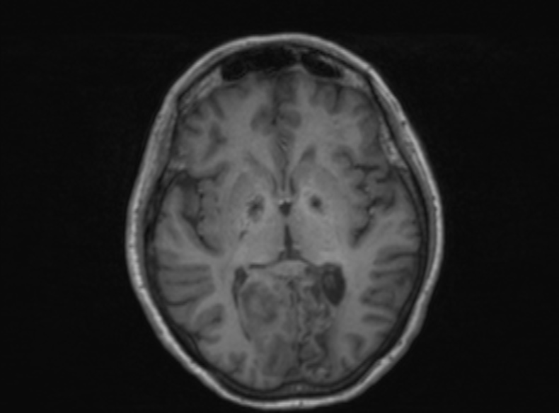Bilateral PCA territory infarction - different ages (Radiopaedia 46200-51784 Axial T1 238).jpg