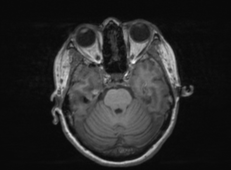 Bilateral PCA territory infarction - different ages (Radiopaedia 46200-51784 Axial T1 288).jpg