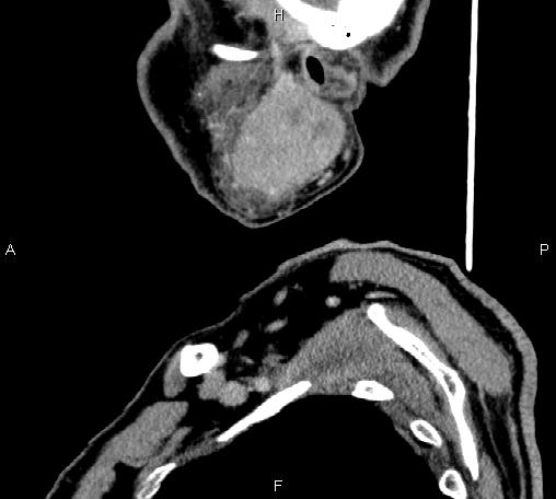 Bilateral Warthin tumors (Radiopaedia 84034-99263 D 66).jpg
