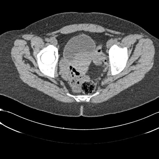 File:Bilateral acetabular protrusion with pincer type femoro-acetabular impingement (Radiopaedia 30134-30733 AXIAL SOFT THIN 28).jpg