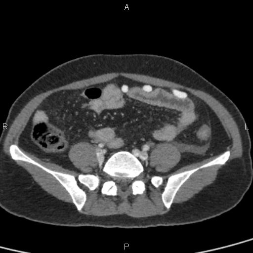 File:Bilateral adrenal gland hyperenhancement in pancreatitis (Radiopaedia 86642-102753 E 80).jpg