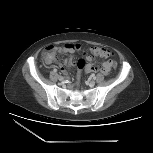 Bilateral adrenal granulocytic sarcomas (chloromas) (Radiopaedia 78375-91007 A 86).jpg