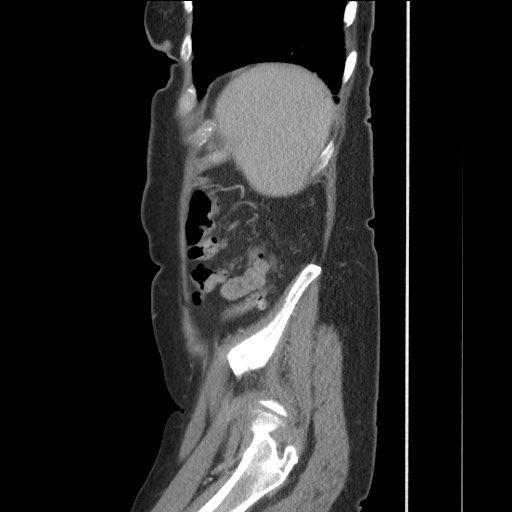 Bilateral adrenal granulocytic sarcomas (chloromas) (Radiopaedia 78375-91007 C 114).jpg