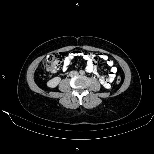 Bilateral adrenal myelolipoma (Radiopaedia 63058-71535 Axial C+ delayed 83).jpg