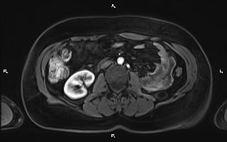 Bilateral adrenal myelolipoma (Radiopaedia 63058-71537 Axial T1 C+ fat sat 58).jpg