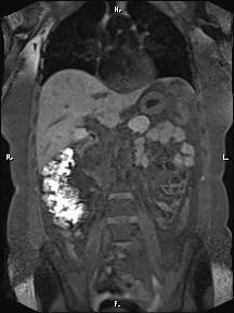 Bilateral adrenal myelolipoma (Radiopaedia 63058-71537 Coronal T1 fat sat 60).jpg