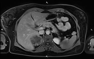 File:Bilateral adrenal myelolipoma (Radiopaedia 63058-71537 H 32).jpg